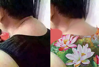 颈椎增生患者