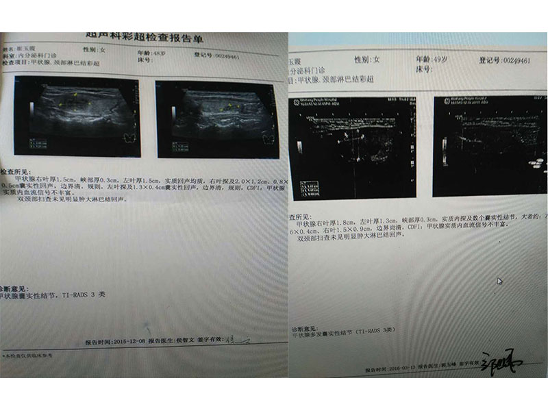 甲状腺囊实行结节调理前后对比