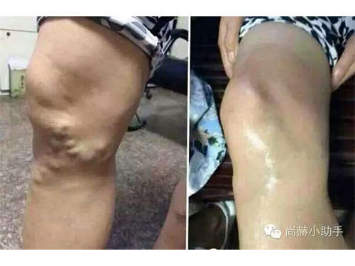 双脚静脉曲张患者