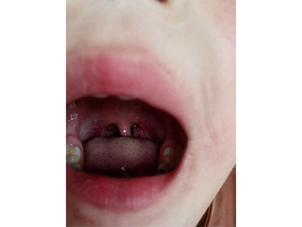 儿科咽喉扁桃体炎调理