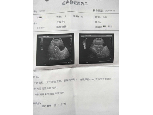 客户49岁！经医院查出左侧妇件27╳18mm囊肿！