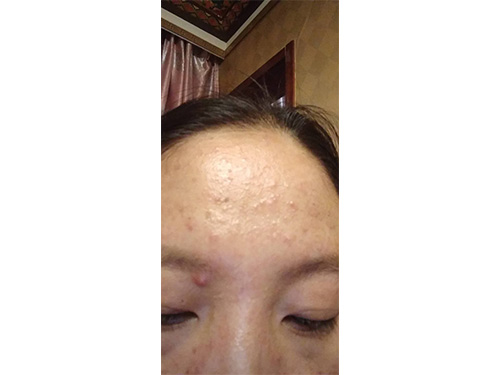 云南客户，面部斑痘