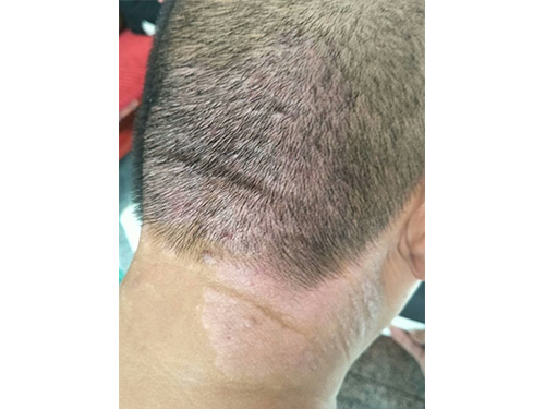 客户！配用秘方（百疹消，较膏等）调理前和二个疗程后的调理效果！