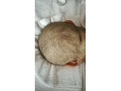 女！40岁！放疗后的乳腺瘤患者，调理六个疗程，基本痊愈！